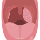 ניתוח שקד שלישי