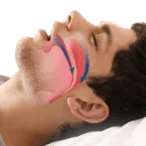 דום נשימה בשינה