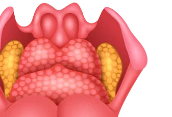 ניתוח שקדים