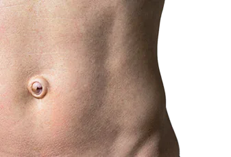 ניתוח בקע טבורי