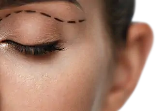 הרמת עפעפיים