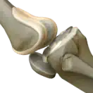 קרע במיניסקוס