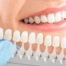 ציפוי חרסינה לשיניים 