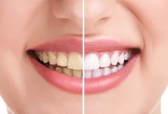  ציפוי למינייט לשיניים
