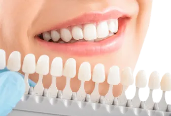 ציפוי חרסינה לשיניים 