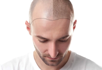 השתלת שיער